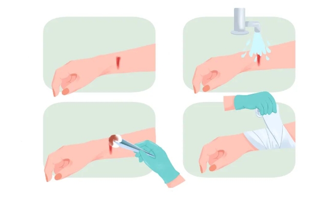 家庭急救指南，创伤后感染预防要点